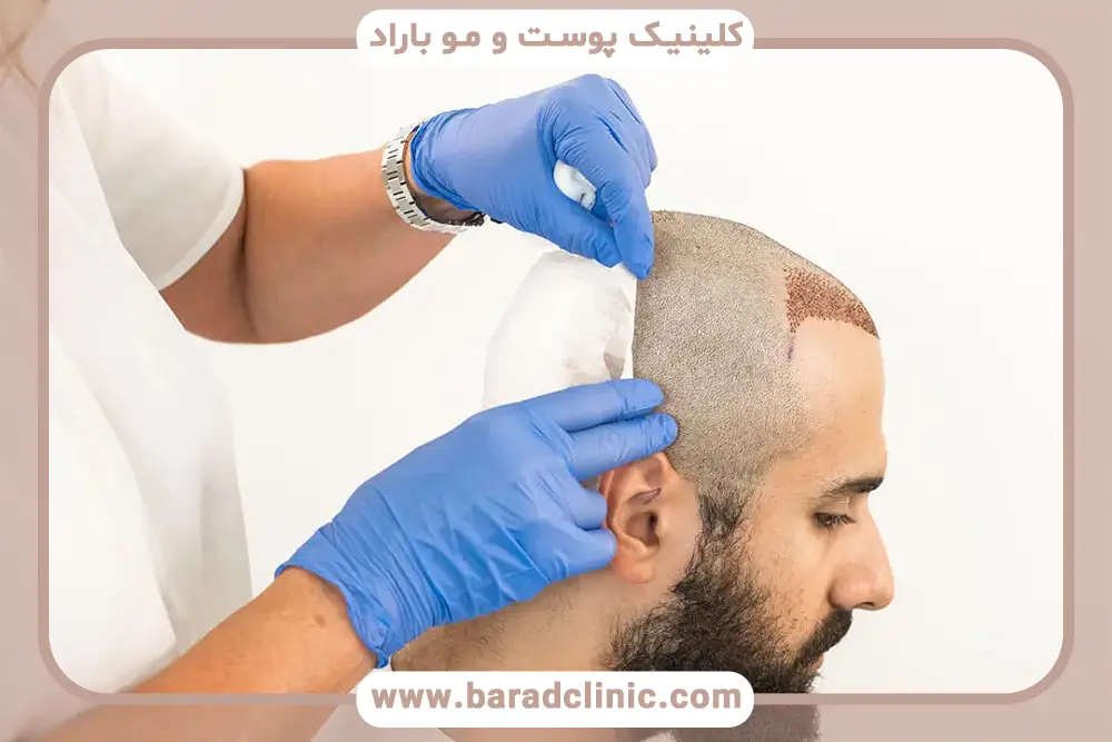 نکات مهم در دوران نقاهت کاشت مو