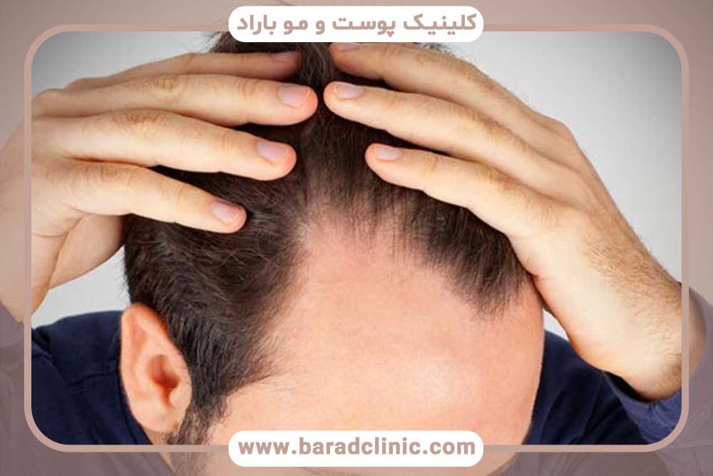 بیماری‌های ریزش مو