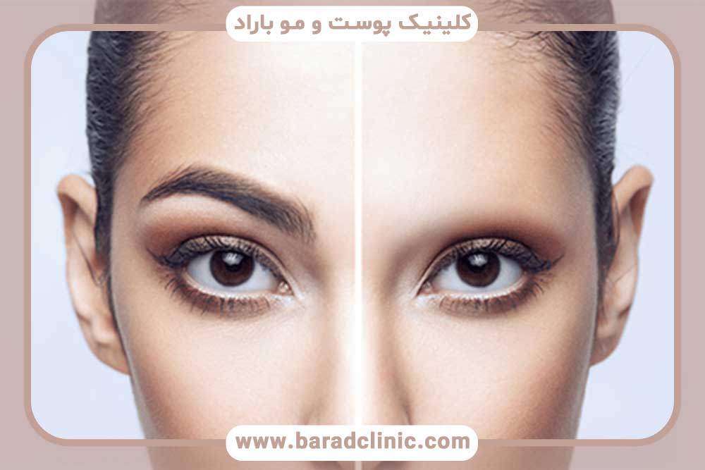 کاشت ابرو حرام است