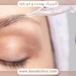 بوتاکس بعد از کاشت ابرو