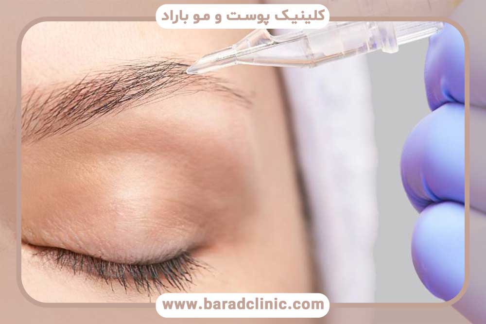 بوتاکس بعد از کاشت ابرو