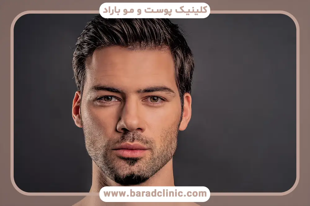 نتایج کاشت ریش طبیعی در تهران