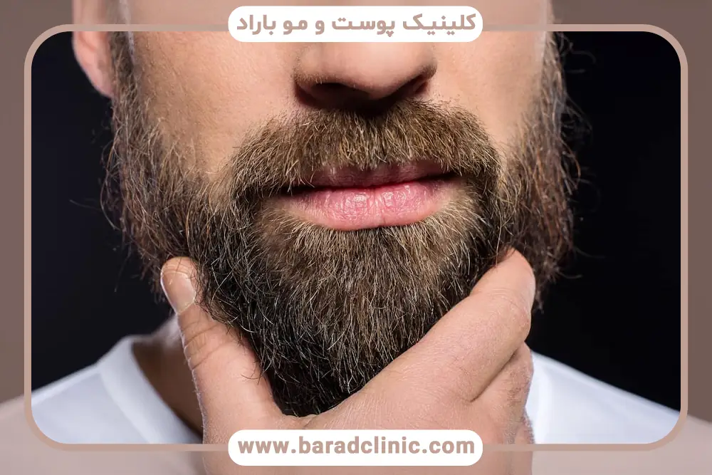 بررسی ماندگاری نتایج در نمونه کاشت ریش