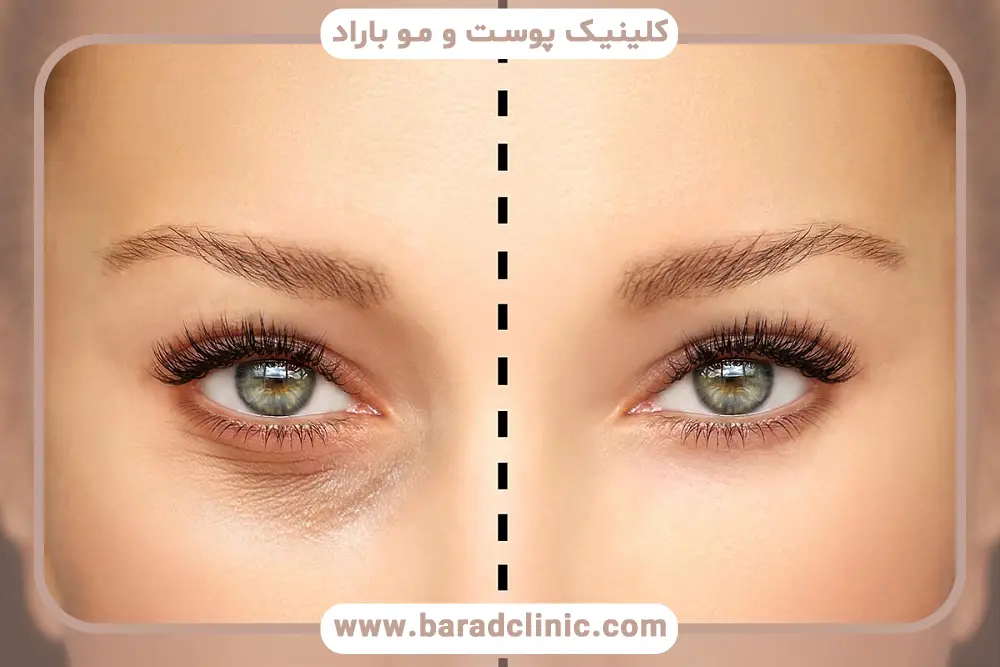 بررسی مراحل عمل در فیلم عمل بلفاروپلاستی با لیزر