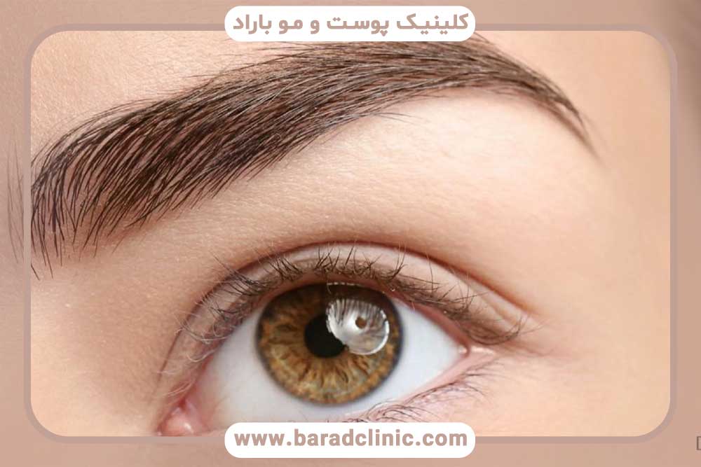 ریزش ابرو در بارداری