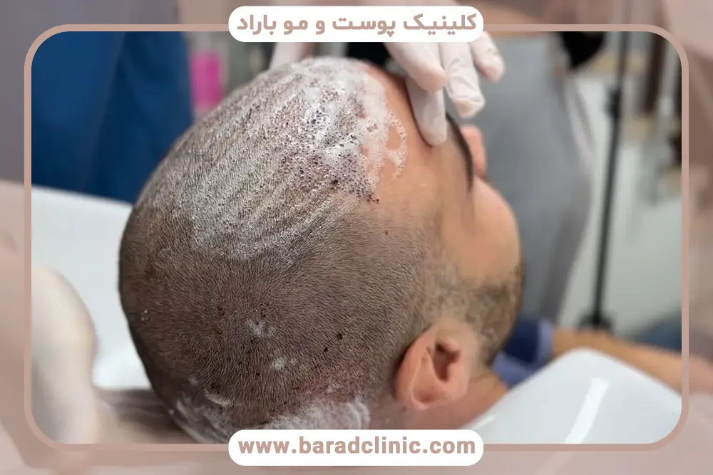 نحوه استفاده از اسپری بعد از کاشت مو