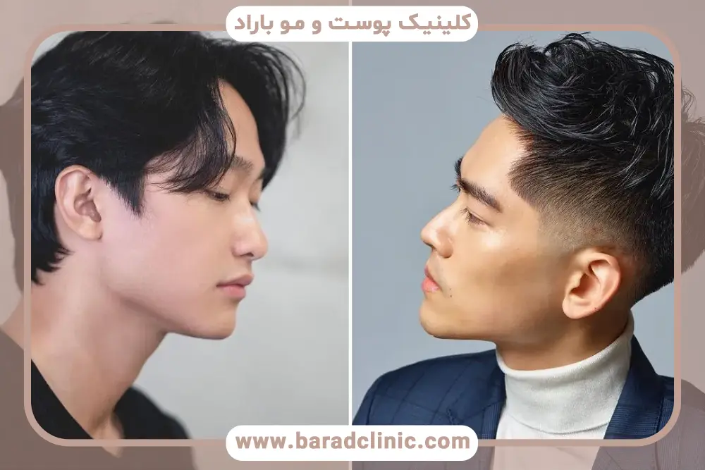 بهترین کاشت مو با روش FIT