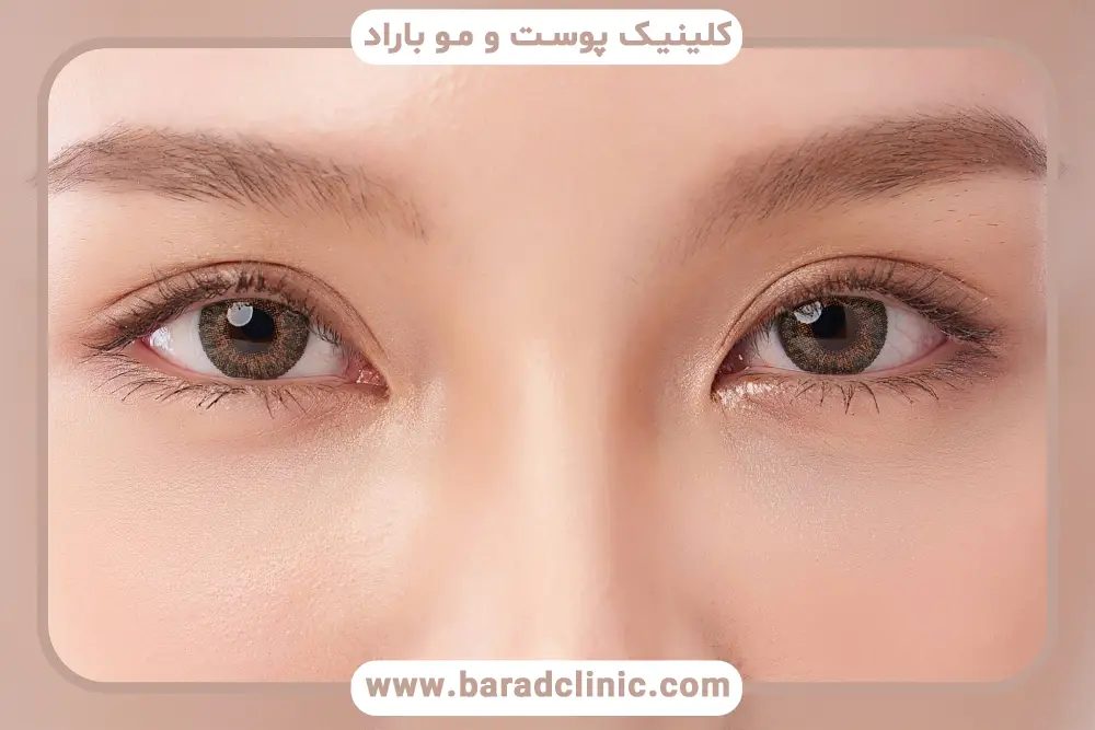 ایا بلفاروپلاستی دائمی است؟ بررسی تاثیر سن و ژنتیک