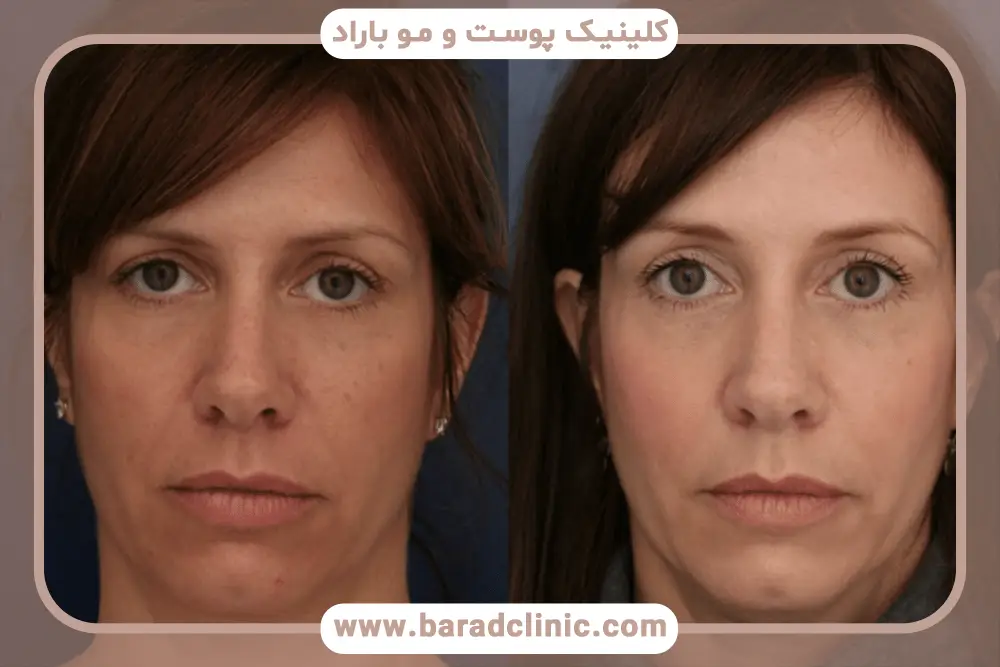 نوع عمل و تاثیر آن روی هزینه عمل بلفاروپلاستی