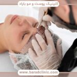 کاشت ابرو طبیعی در تهران