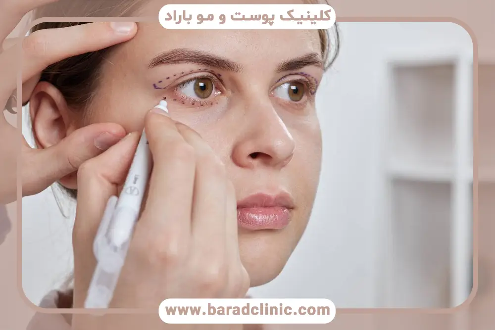 خستگی چشم از مهمترین عوارض بلفاروپلاستی پلک بالا