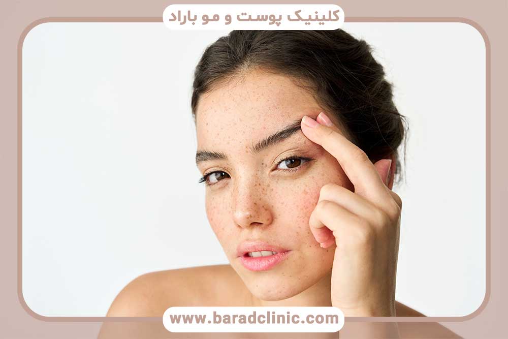 برداشت فلپ در کاشت ابرو