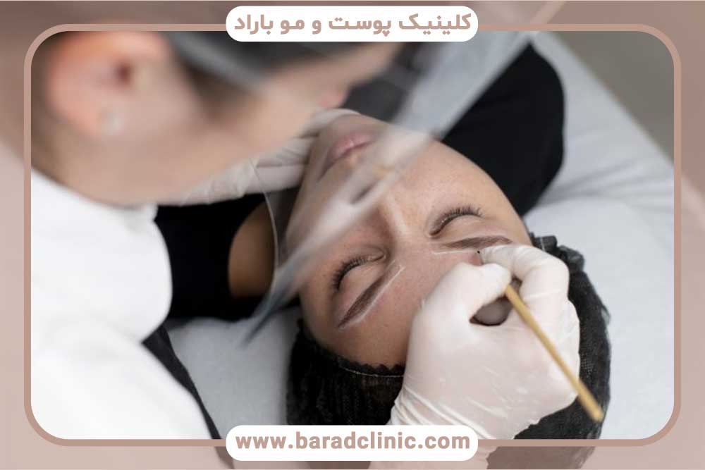 کاشت ابرو قبل و بعد