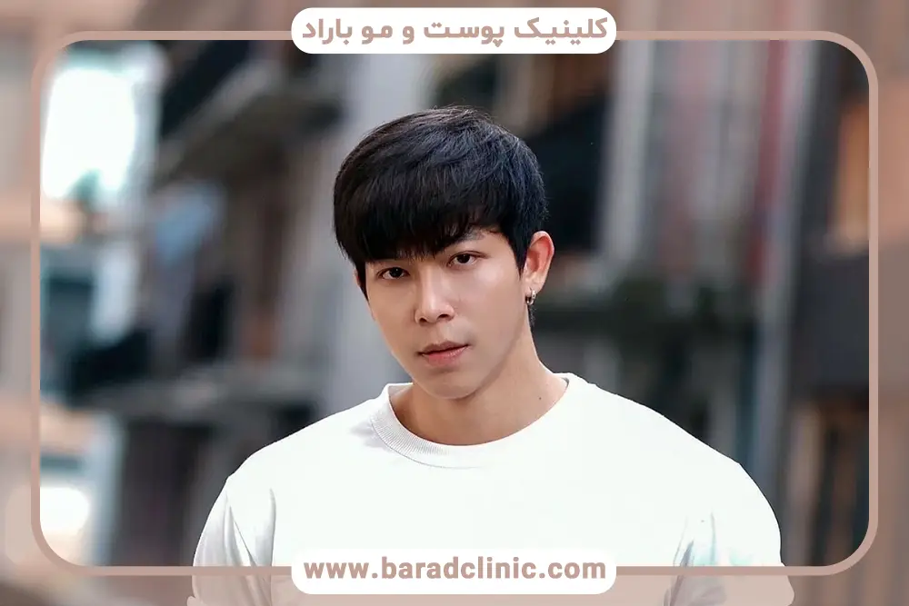 هزینه کاشت مو در تهران و در کلینیک‌های لوکس