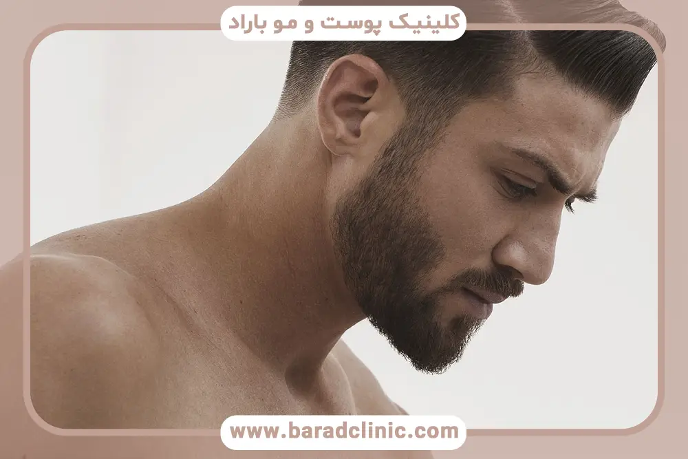 کاندیدای مناسب کاشت ریش به روش fit