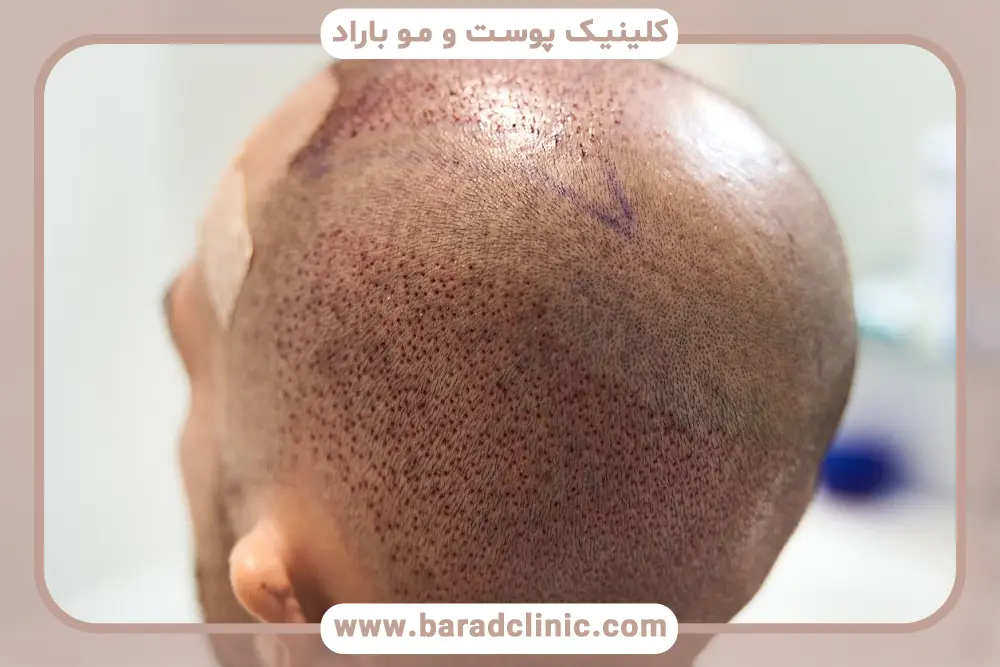 نحوه بررسی کیفیت فیلم کاشت مو به روش sut