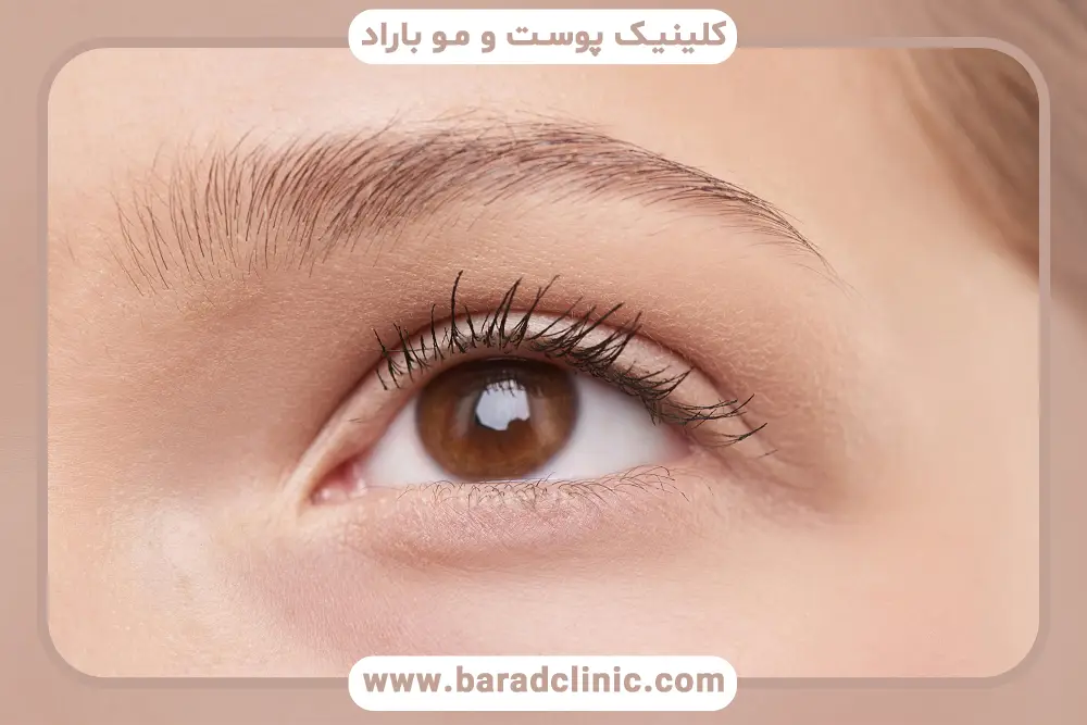 مزایای بلفاروپلاستی بدون بخیه