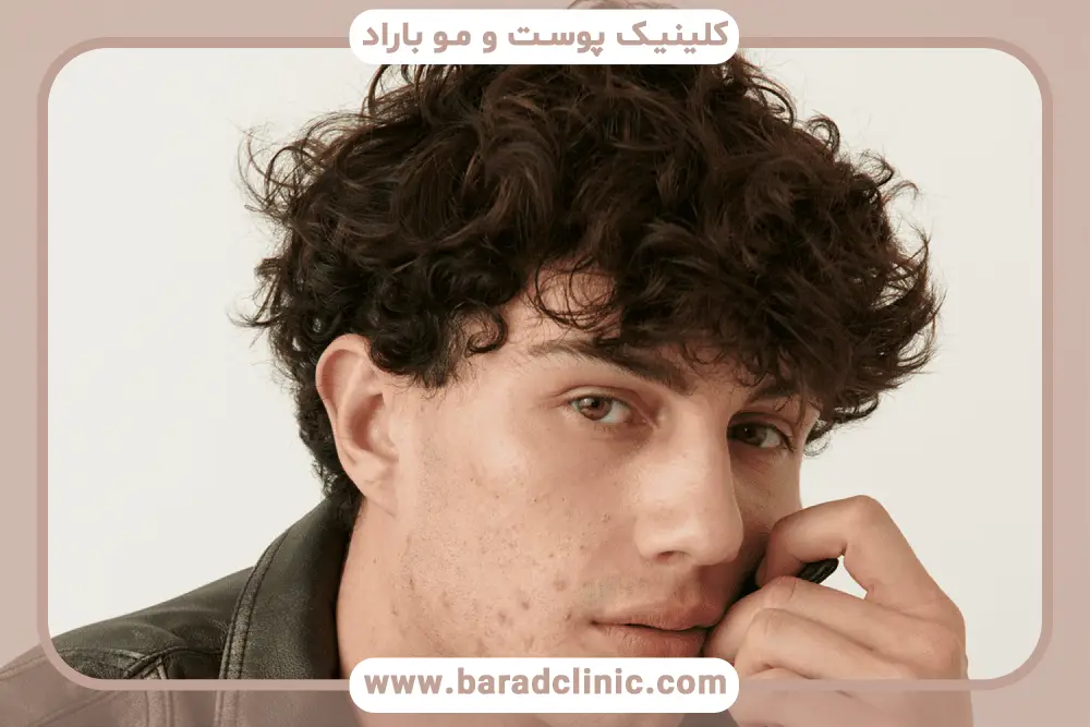 مزایای کاشت مو به روش fut