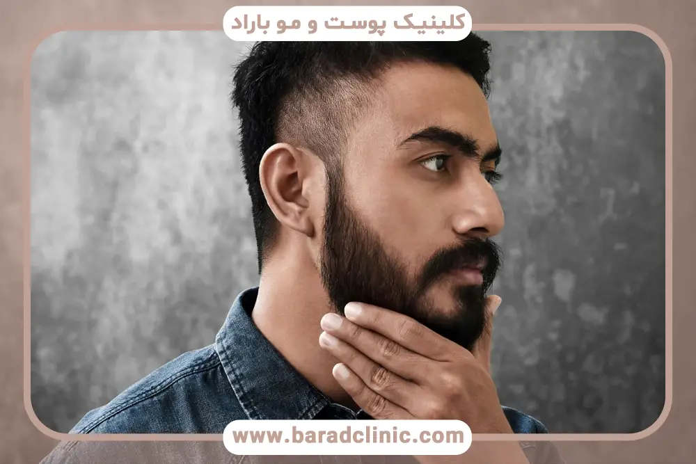 نحوه کاشت ریش به صورت گام به گام