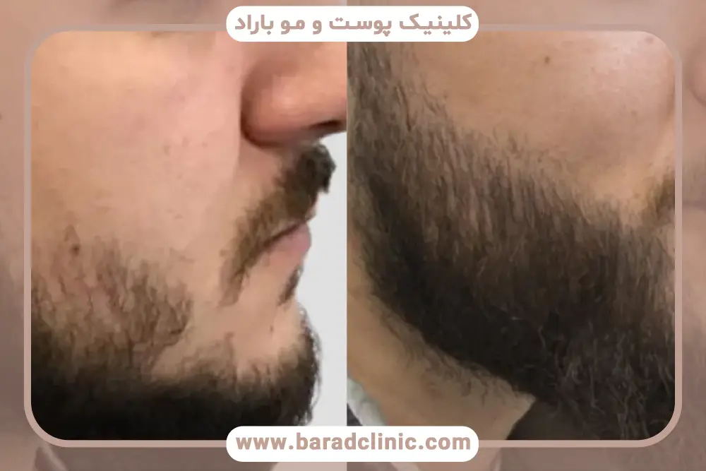 تکنیک‌های مدرن کاشت ریش زیر لب