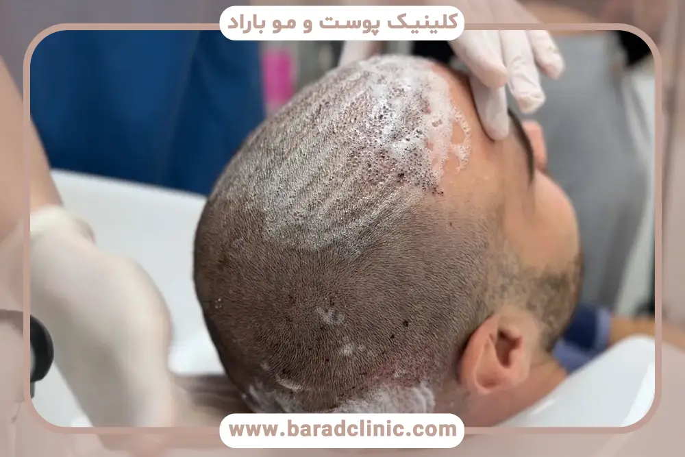 مزایای اسپری نیتروگلیسیرین برای کاشت مو 