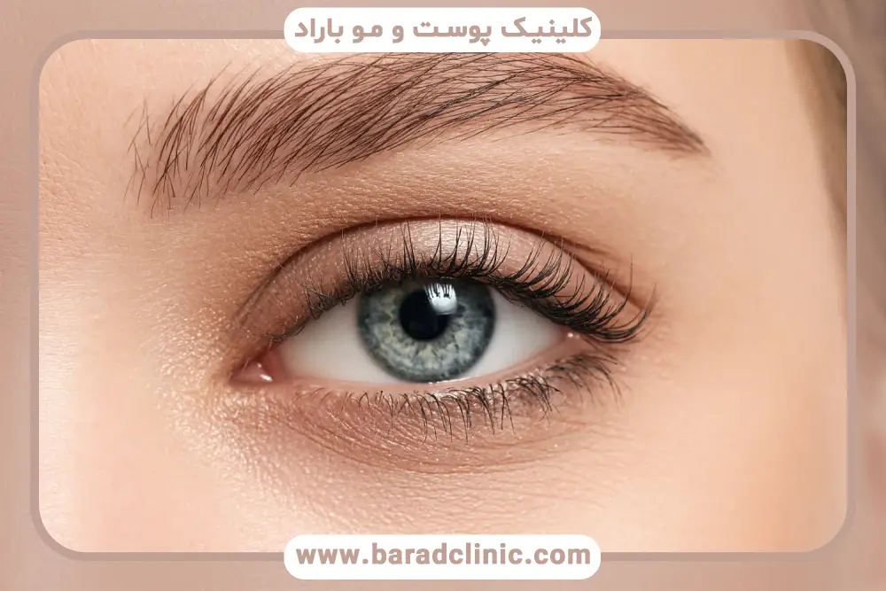 نقش تکنیک جراح در ریزش مژه بعد از بلفاروپلاستی