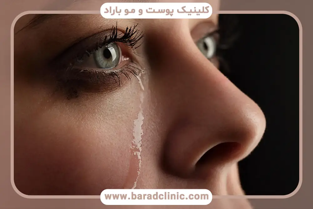 انسداد مجرای چشم علت آبریزش چشم بعد از عمل بلفاروپلاستی