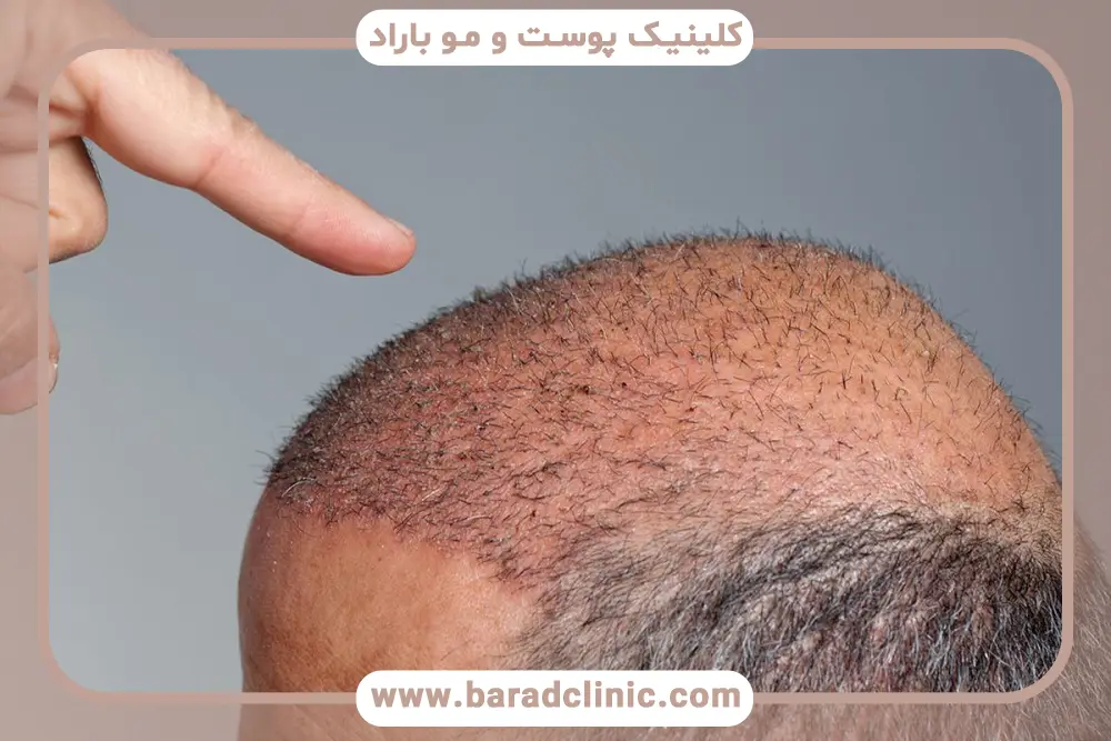 تغذیه مناسب در دوران نقاهت کاشت مو