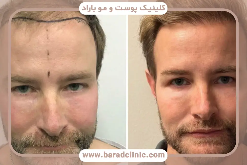 هفته دوم تا سوم دوره کاشت مو