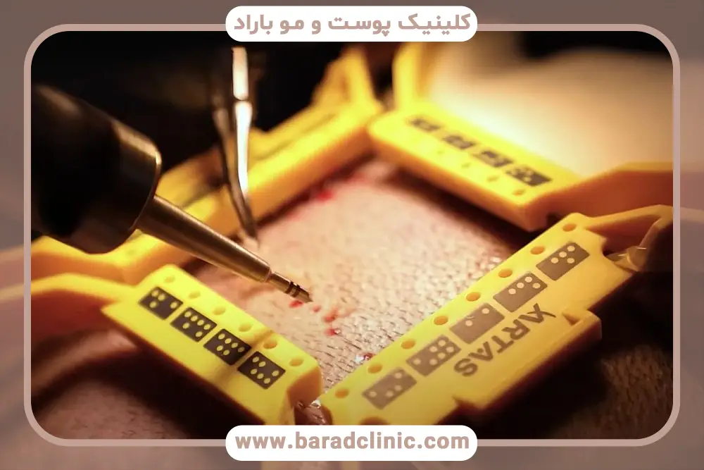 سرعت بالا در کاشت مو با دستگاه تمام اتوماتیک