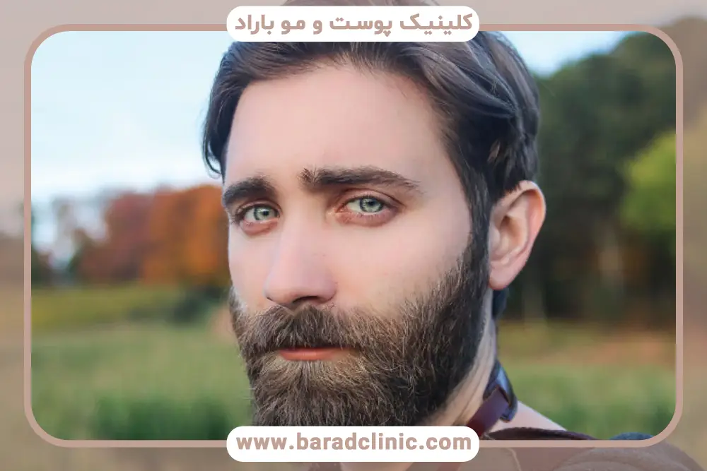 نتایج کاشت ریش طبیعی در تهران