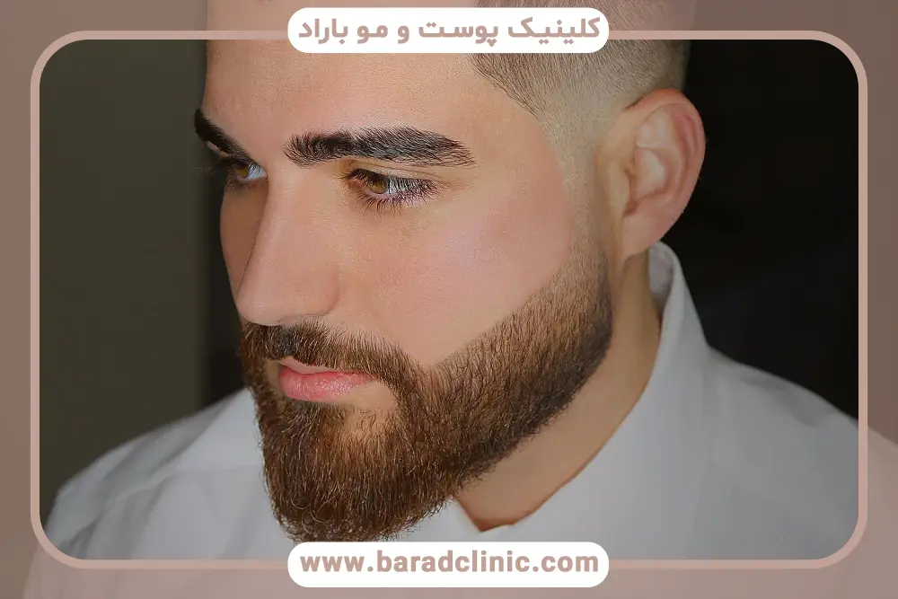 انواع روش‌های کاشت ریش