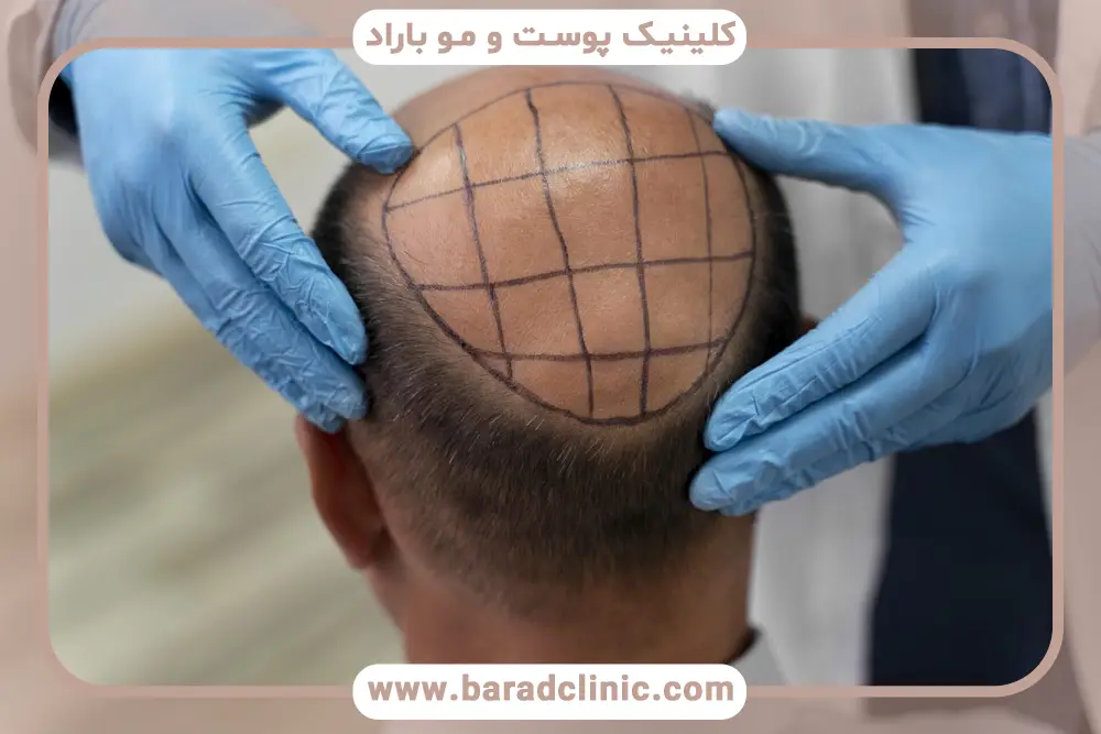 نتیجه کاشت مو بعد از چند ماه مشخص میشود؟ نقش مراقبت‌ها در نتایج نهایی