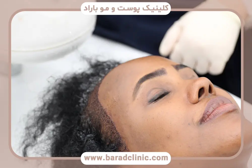 اشتباهات رایج در استفاده از اسپری بعد از کاشت مو