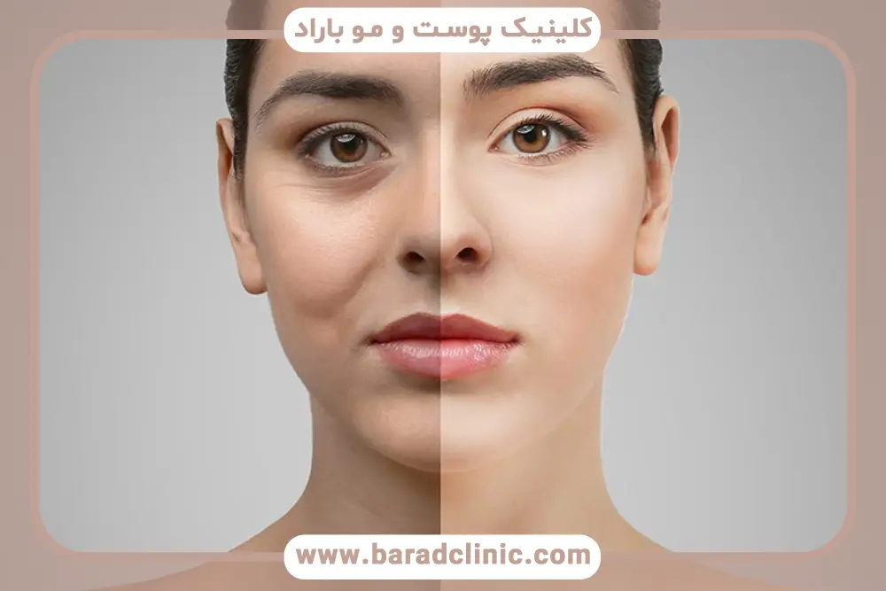 هزینه پیش از عمل بلفاروپلاستی