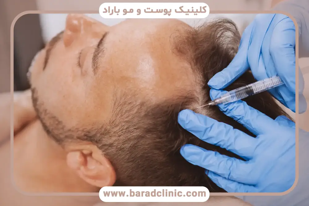 مقایسه prp موها با سایر روشها