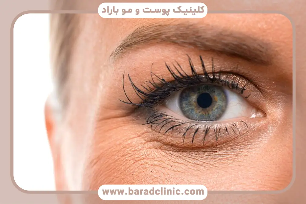 خط بخیه از عوارض بلفاروپلاستی پلک بالا