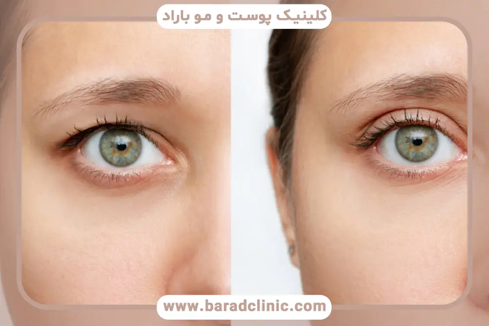 مزایای بلفاروپلاستی از زیر ابرو