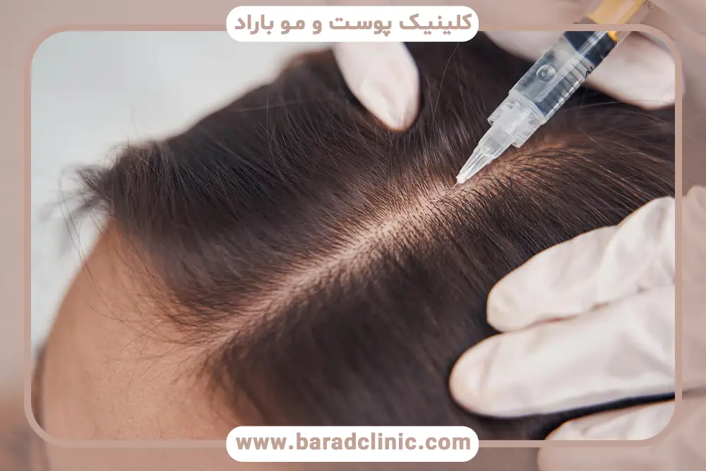 عوارض و نکات ایمنی مزوتراپی برای پرپشتی مو