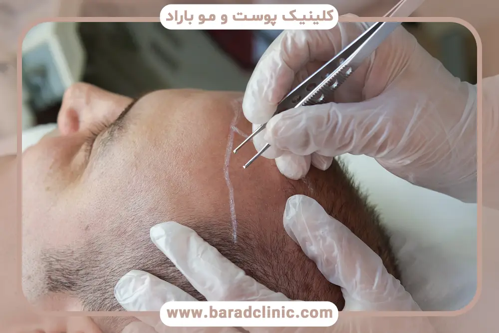بررسی طبیعی بودن نتایج در فیلم کاشت مو به روش sut