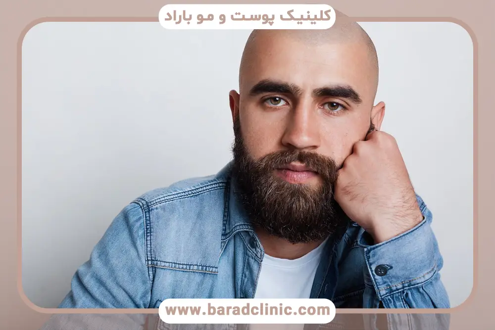 عوارض احتمالی کاشت ریش در صورت