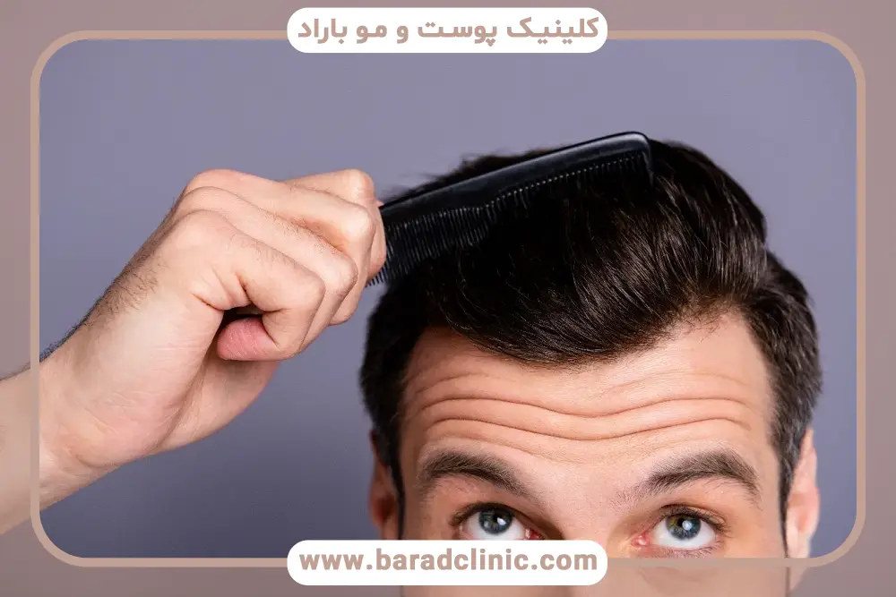 کاندیدای مناسب کاشت مو به روش fut