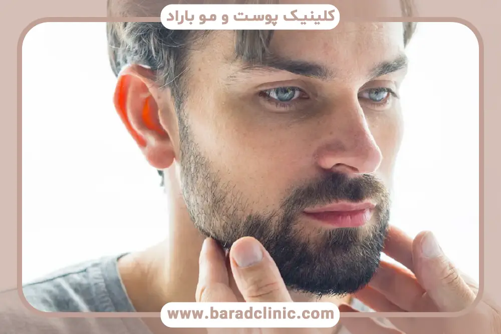 بهبودی بعد از کاشت ریش
