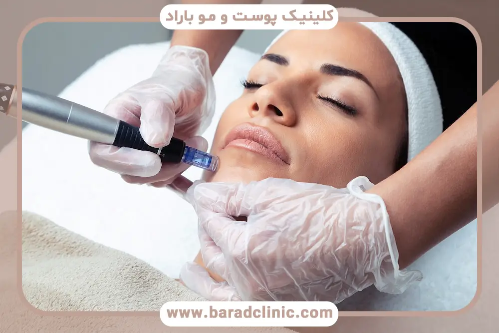 نتایج مزوتراپی برای جای جوش