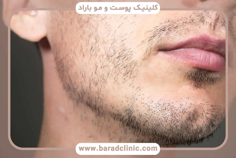 نتایج کاشت ریش زیر لب