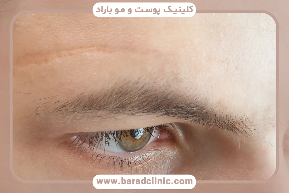 مراقبت‌های قبل و بعد بلفاروپلاستی ترکیبی