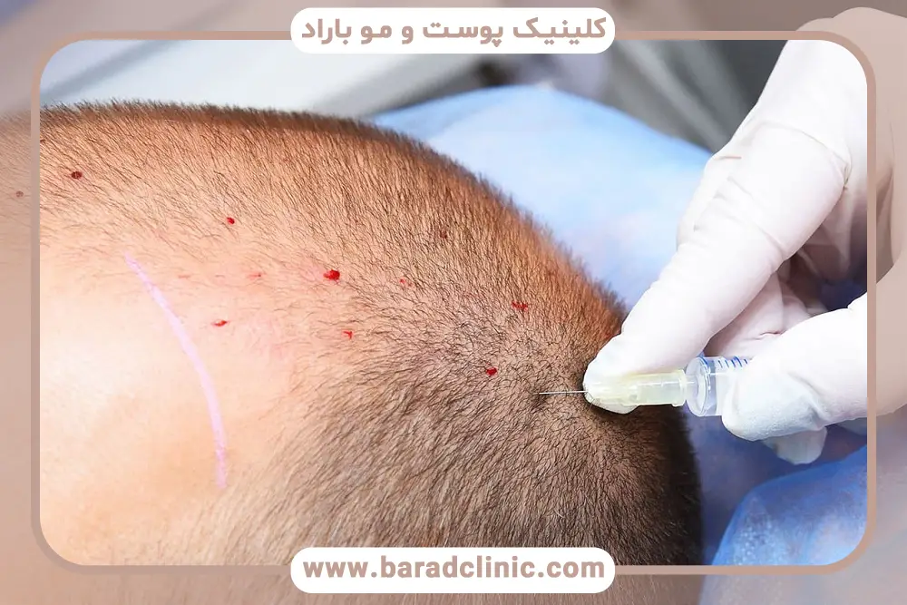 عوارض جانبی اسپری نیتروگلیسیرین برای کاشت مو 