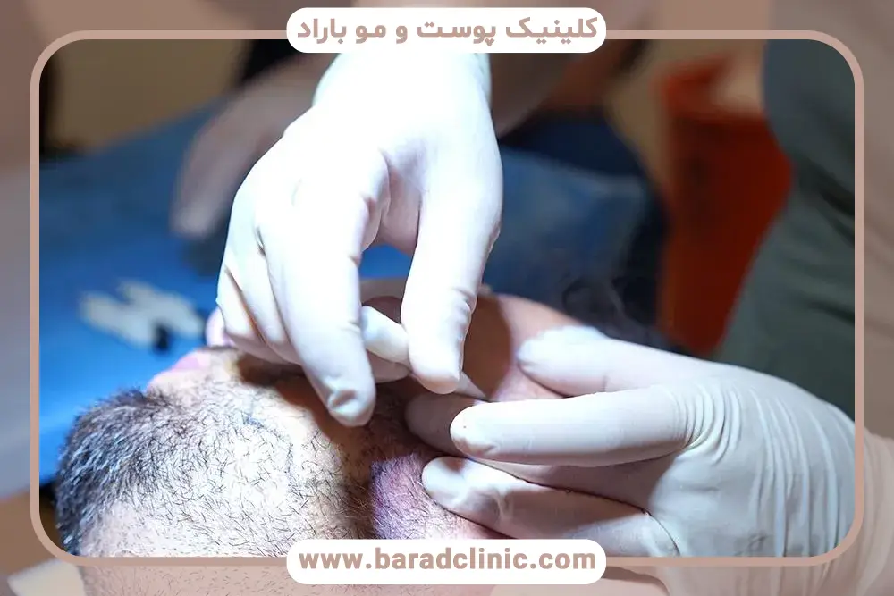 تاثیر سبک زندگی روی بهبودی زخم کاشت ریش