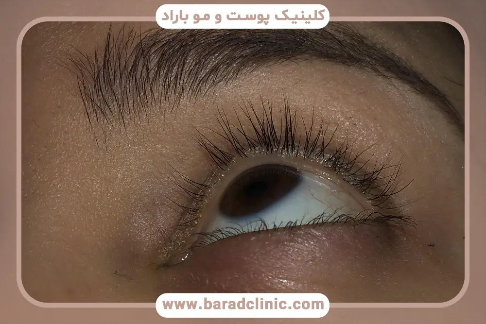 درمان ریزش مژه بعد از بلفاروپلاستی