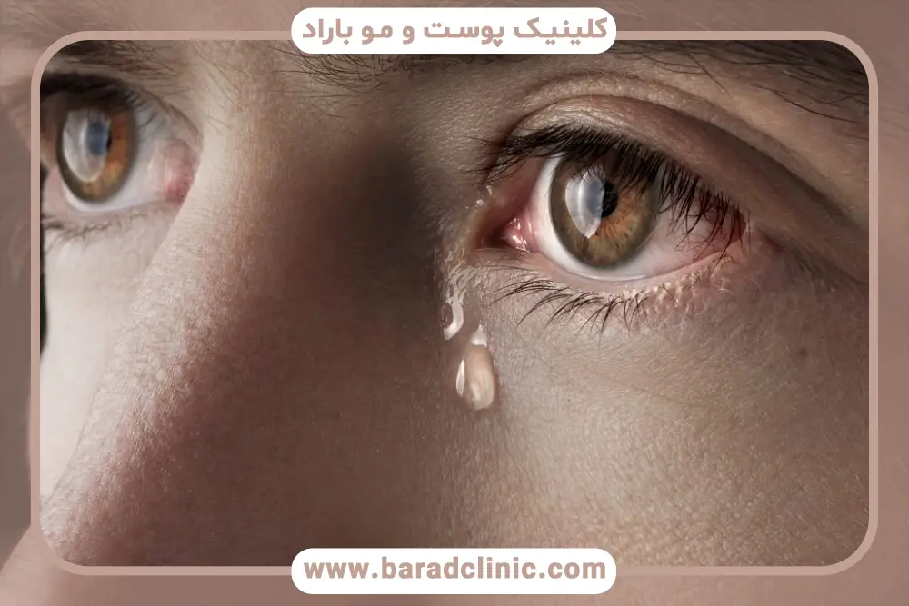 عفونت علت آبریزش چشم بعد از عمل بلفاروپلاستی